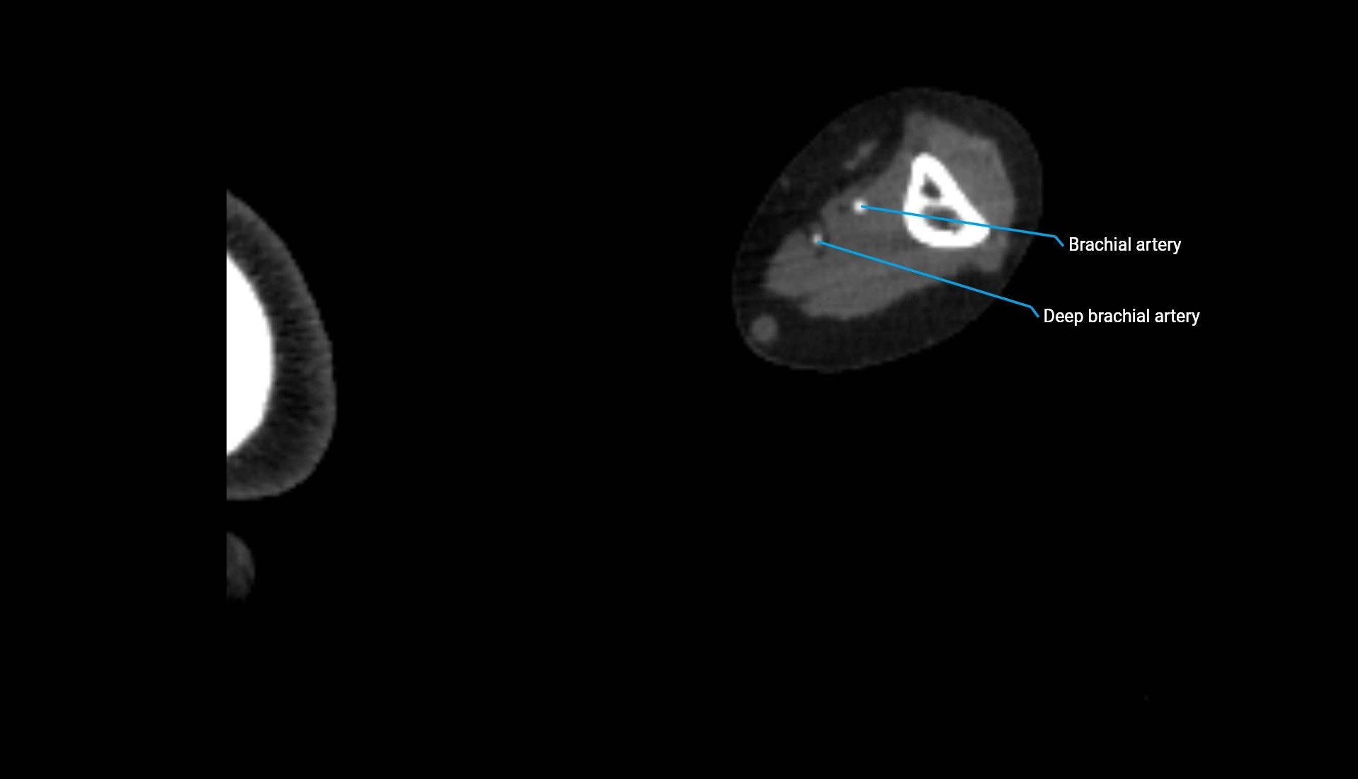 CTA upper limb axial cross sectional anatomy labelled image 208 (2).webp